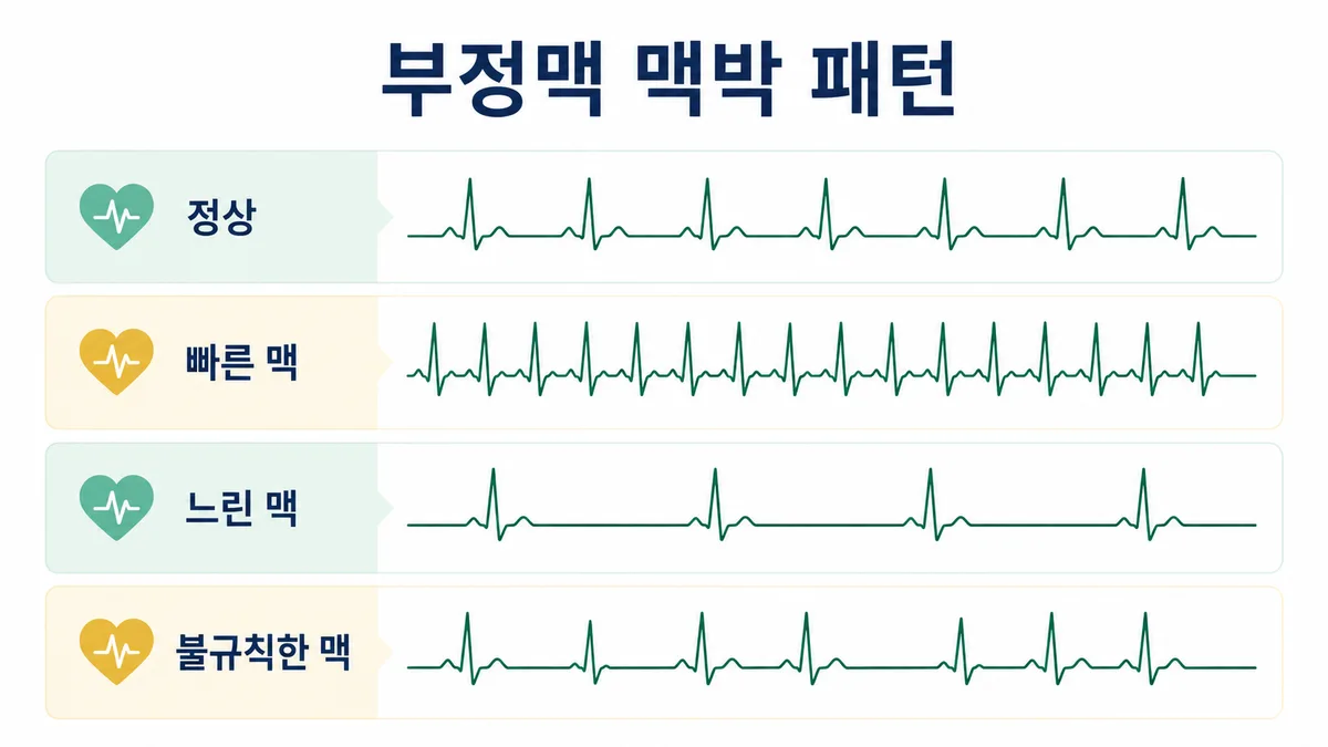 부정맥 심전도 파형 비교 도표 — 정상 맥, 빠른 맥, 느린 맥, 불규칙한 맥