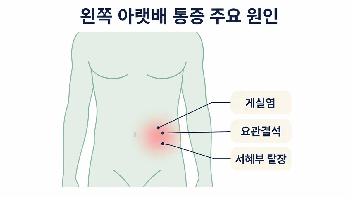 남자 왼쪽 아랫배 통증의 주요 원인 위치 도표 — 게실염, 요관결석, 서혜부 탈장