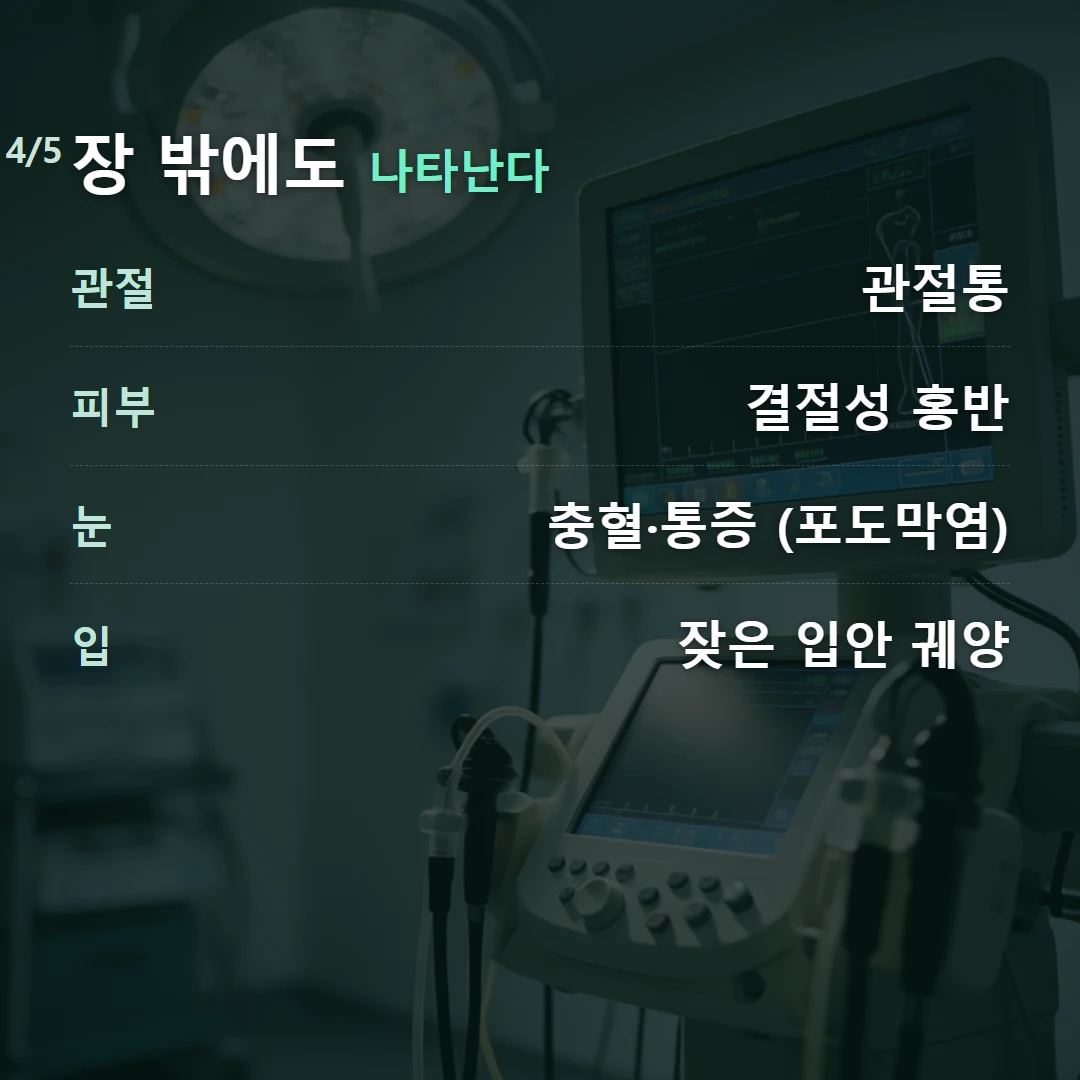 장 밖에도 나타난다 — 관절 관절통, 피부 결절성 홍반, 눈 충혈·통증 (포도막염), 입 잦은 입안 궤양