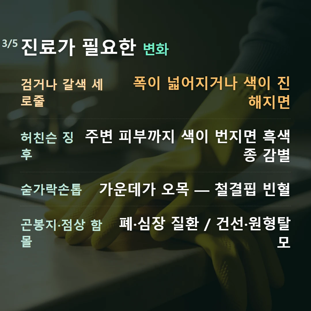 진료가 필요한 변화 — 검거나 갈색 세로줄 폭이 넓어지거나 색이 진해지면, 허친슨 징후 주변 피부까지 색이 번지면 흑색종 감별, 숟가락손톱 가운데가 오목 — 철결핍 빈혈, 곤봉지·점상 함몰 폐·심장 질환 / 건선·원형탈모