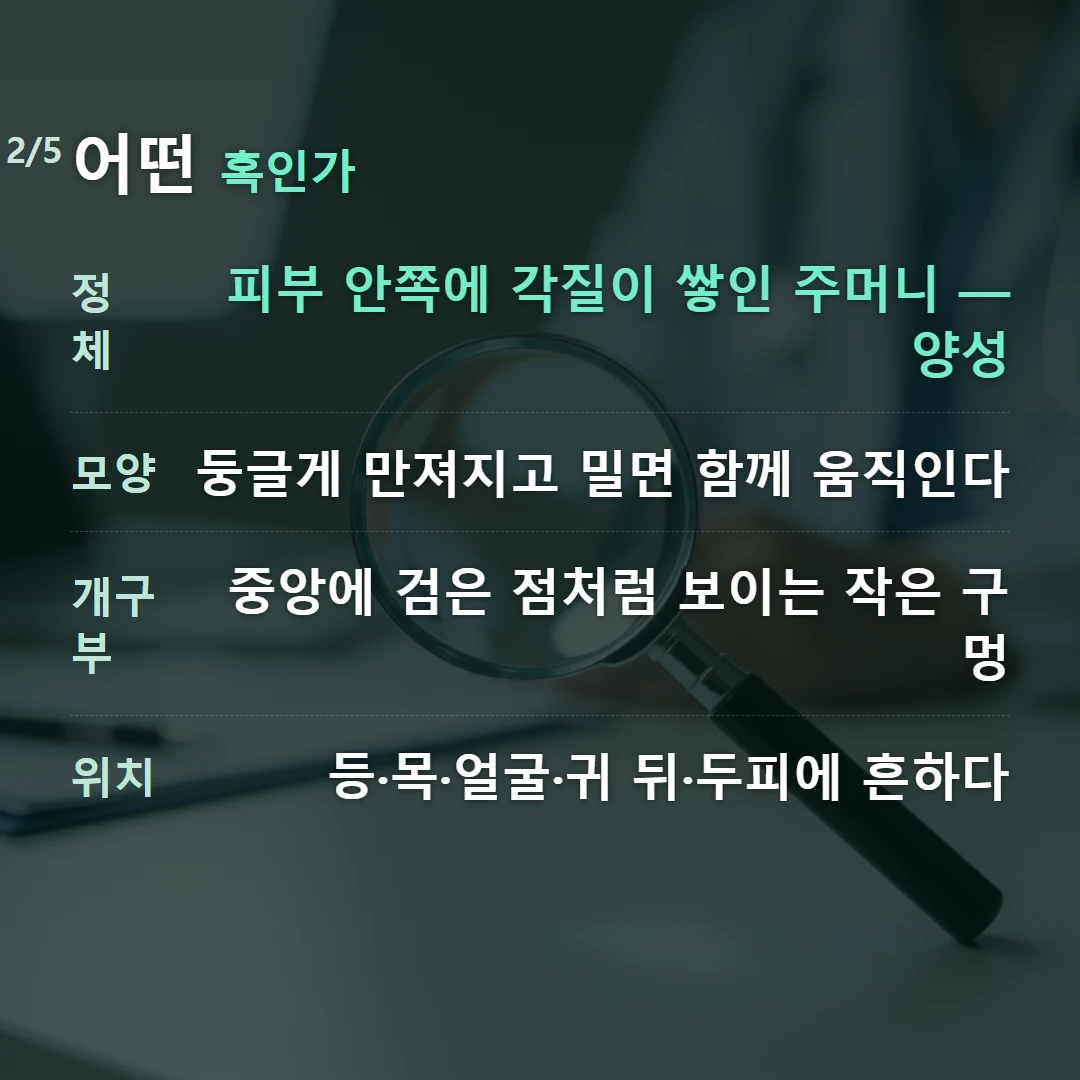 어떤 혹인가 — 정체 피부 안쪽에 각질이 쌓인 주머니 — 양성, 모양 둥글게 만져지고 밀면 함께 움직인다, 개구부 중앙에 검은 점처럼 보이는 작은 구멍, 위치 등·목·얼굴·귀 뒤·두피에 흔하다
